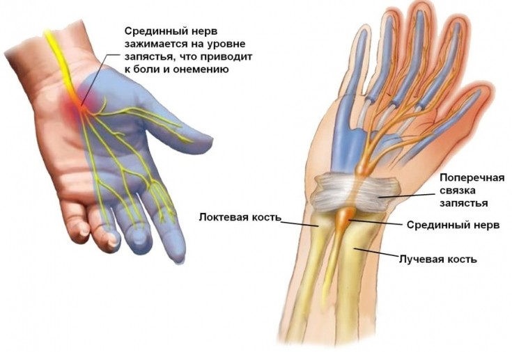 Туннельный синдром у музыкантов